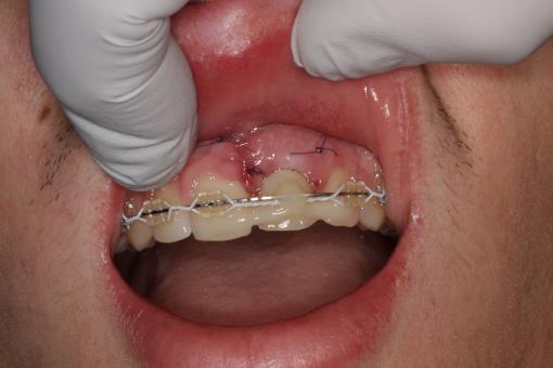 Ekstrakcija zoba in nadomestitev z implantatom in dograditev kosti