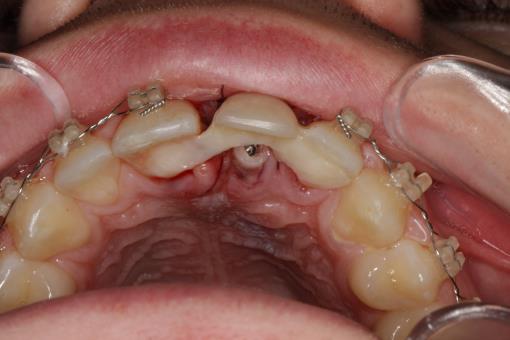 Takojšnja izdelava provizorija na implantatu